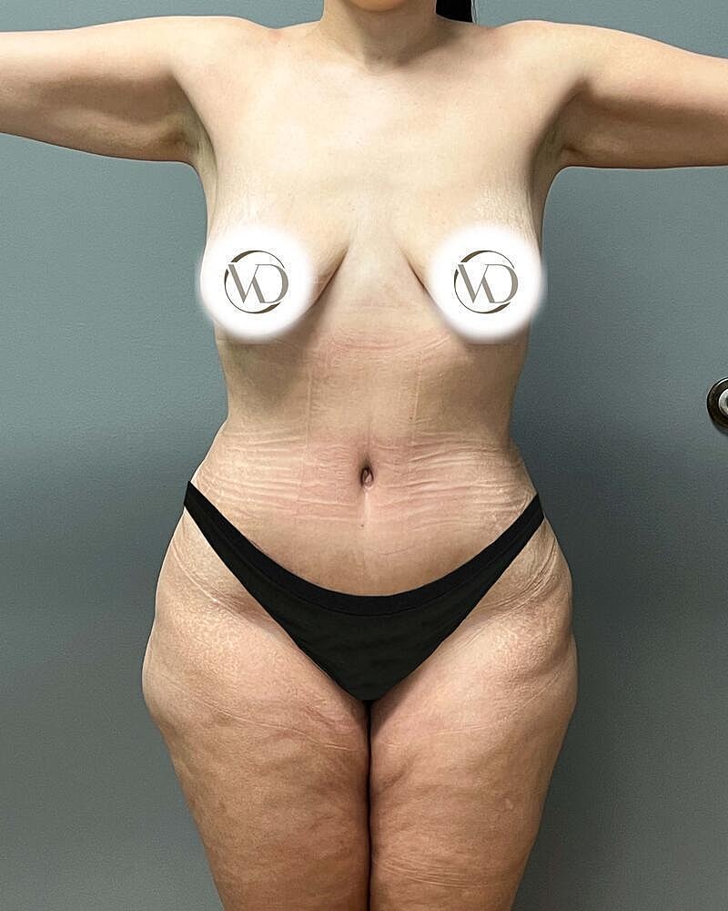 Tummy Tuck Before & After