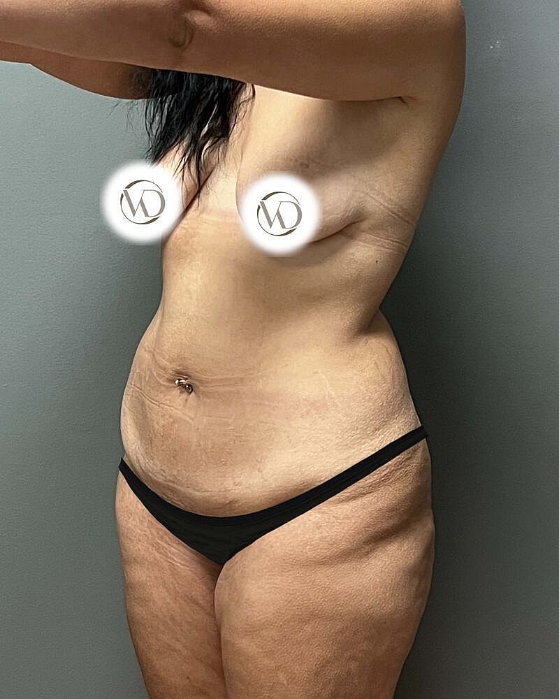 Tummy Tuck Before & After