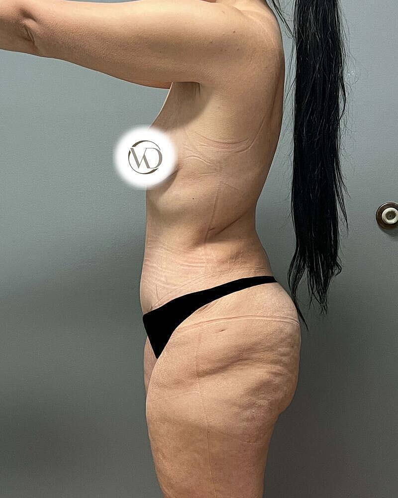Tummy Tuck Before & After