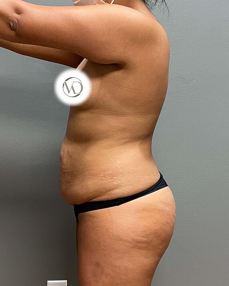 Tummy Tuck Before & After