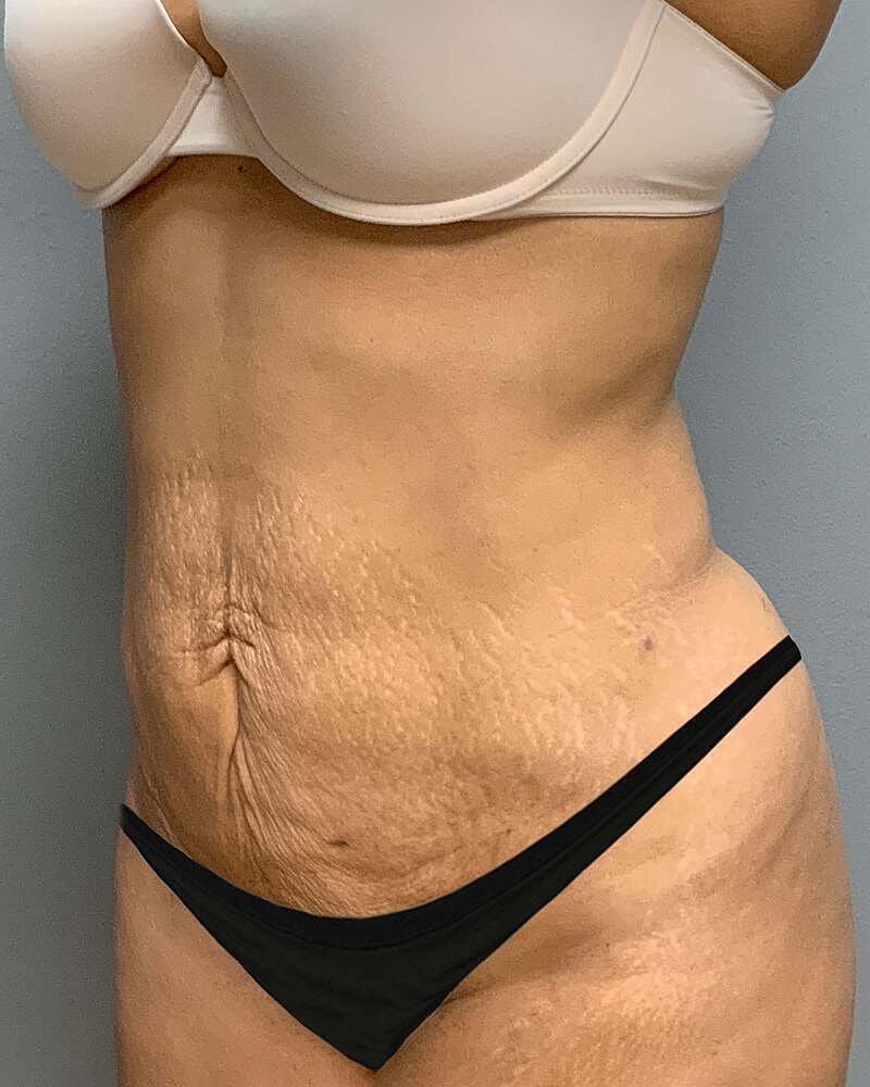 Tummy Tuck Before & After