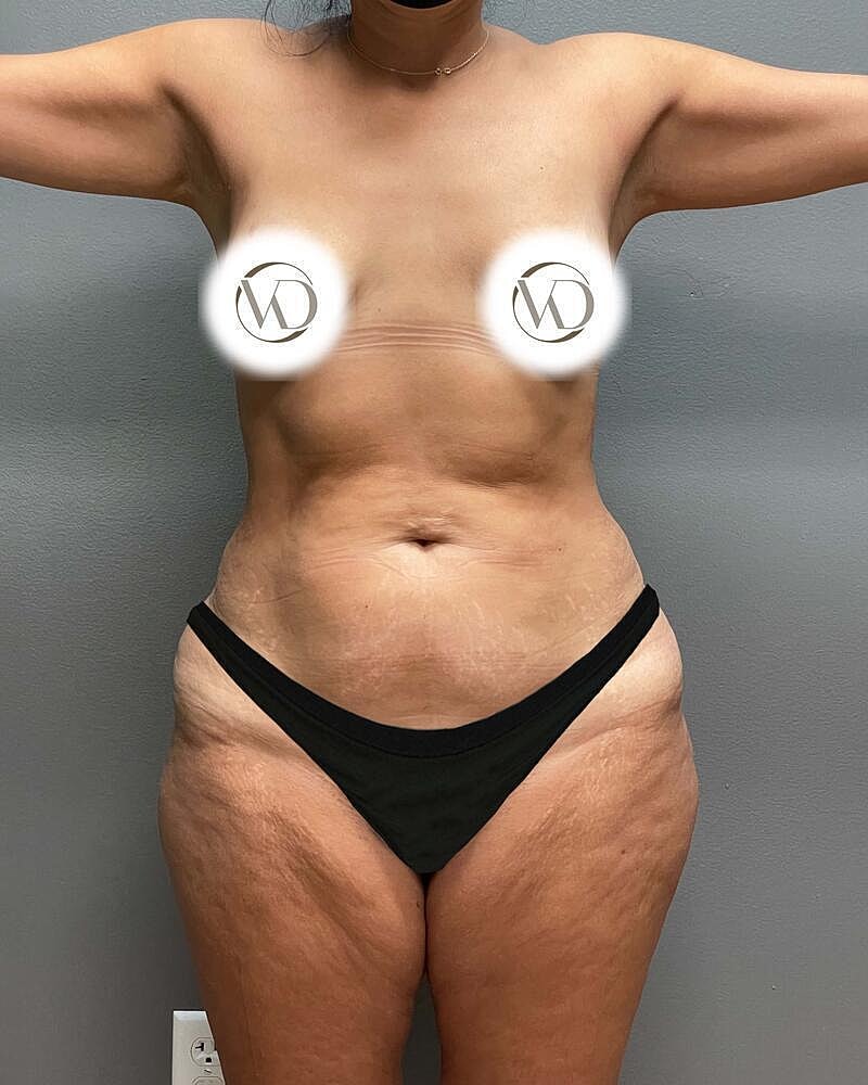 Tummy Tuck Before & After