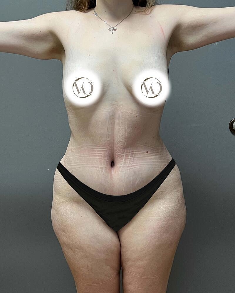 Tummy Tuck Before & After