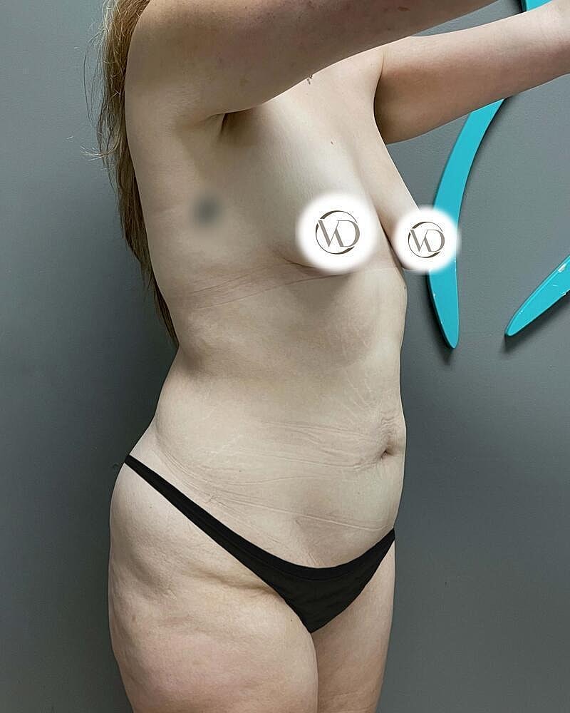 Tummy Tuck Before & After