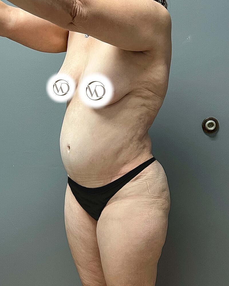 Tummy Tuck Before & After