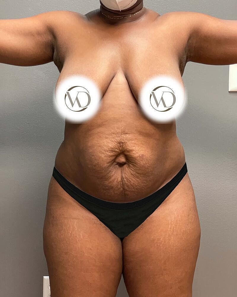 Tummy Tuck Before & After
