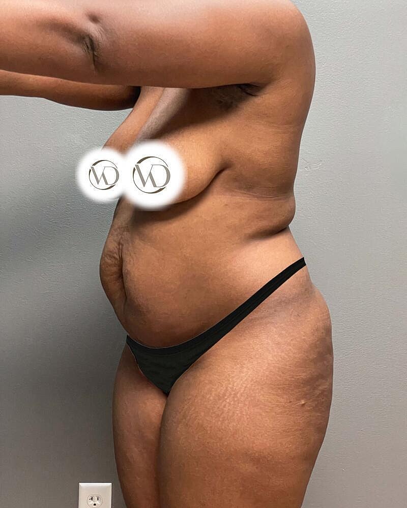 Tummy Tuck Before & After