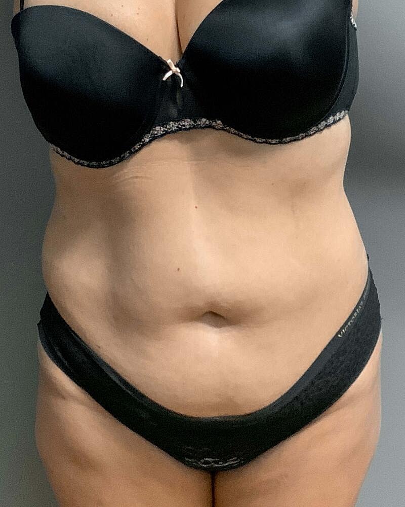 Tummy Tuck Before & After