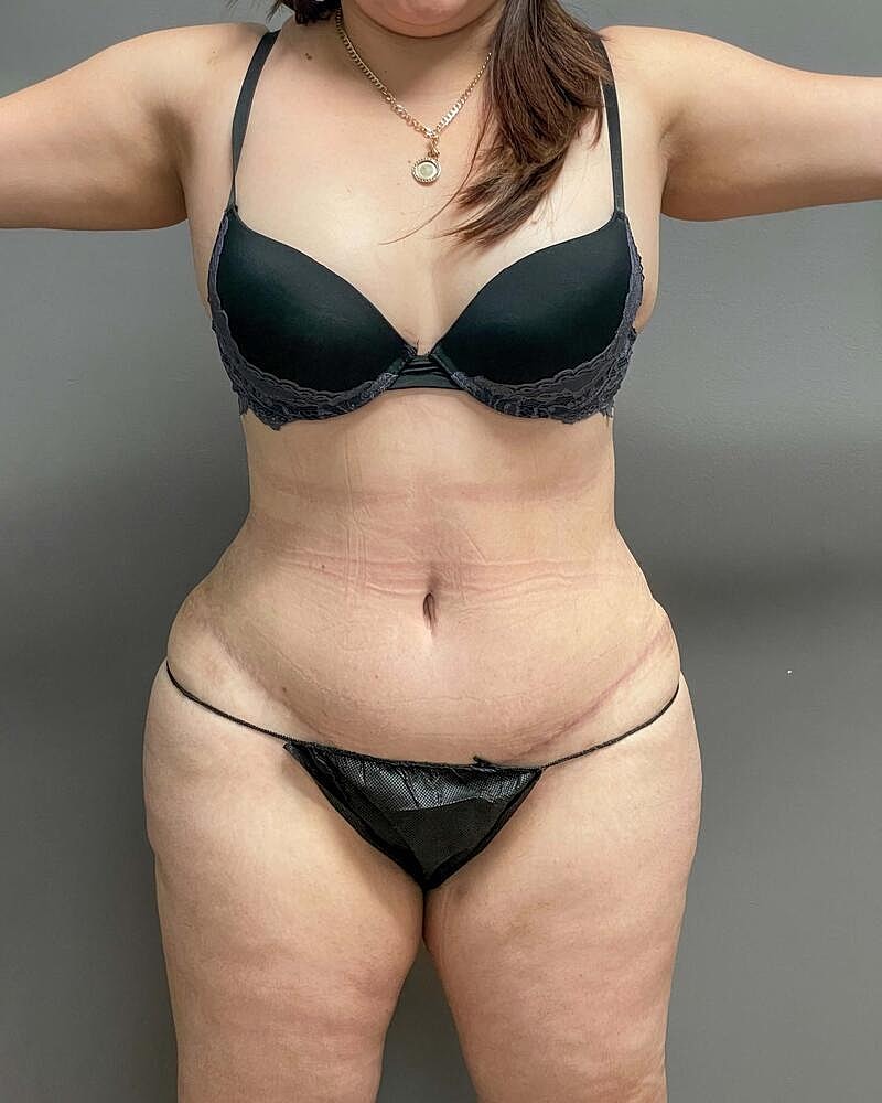 Tummy Tuck Before & After