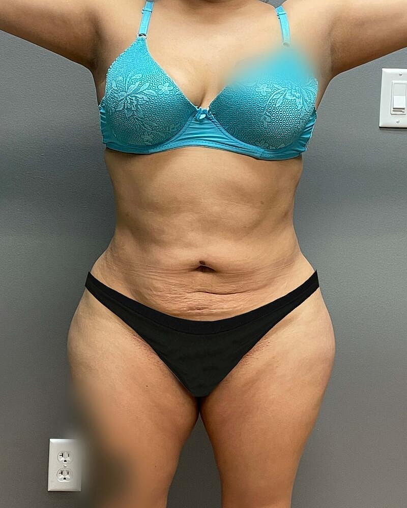Tummy Tuck Before & After