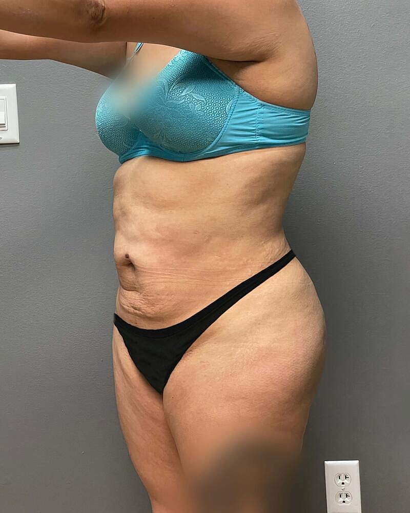 Tummy Tuck Before & After