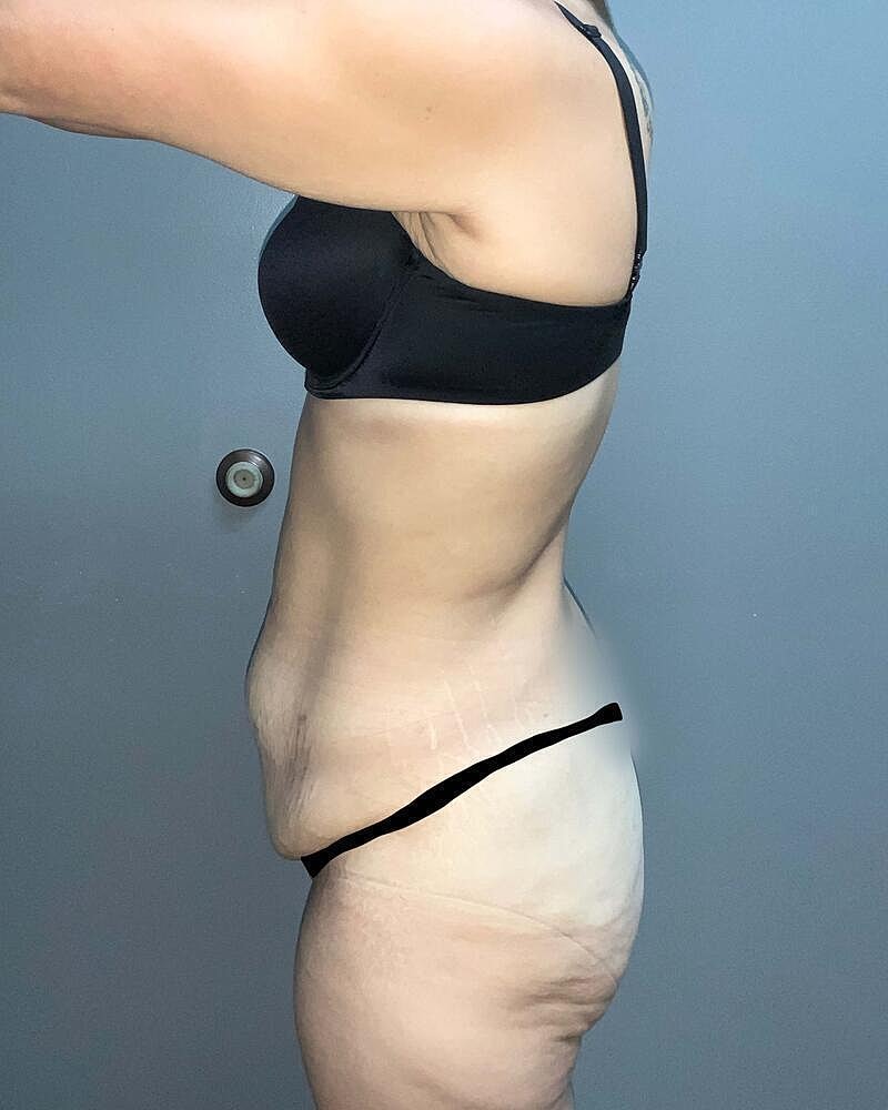 Tummy Tuck Before & After