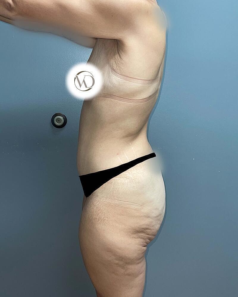 Tummy Tuck Before & After