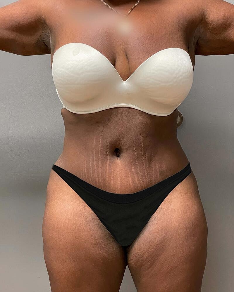 Tummy Tuck Before & After