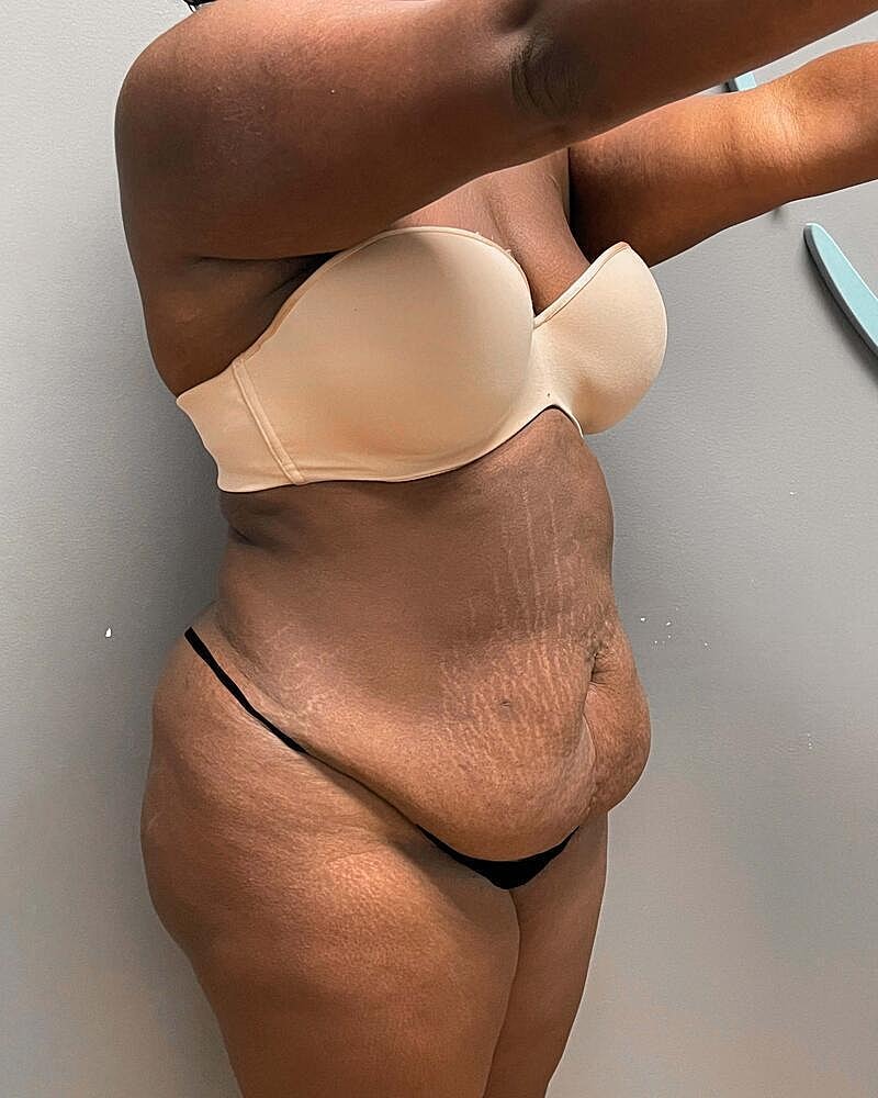 Tummy Tuck Before & After