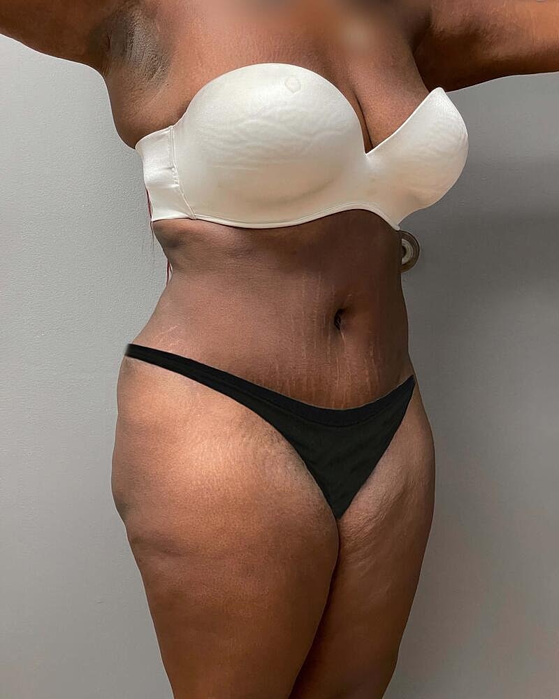 Tummy Tuck Before & After