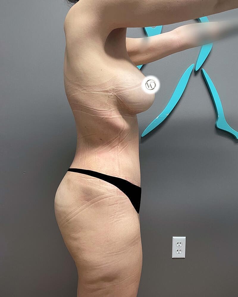 Tummy Tuck Before & After