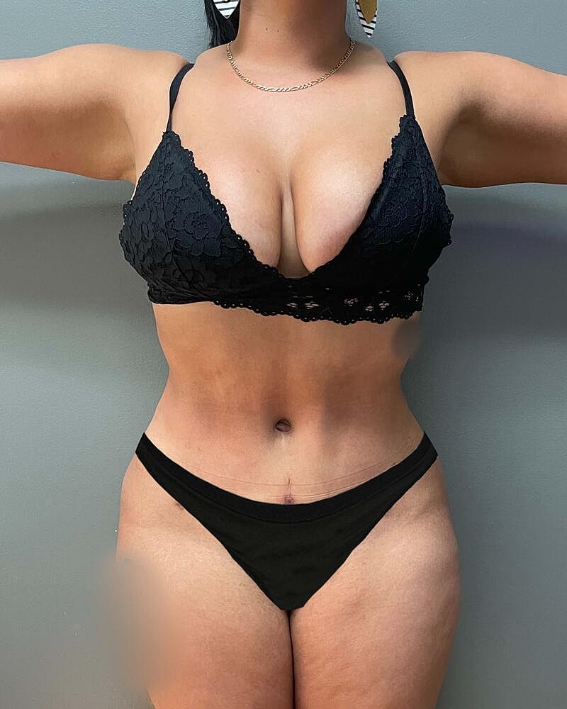 Tummy Tuck Before & After