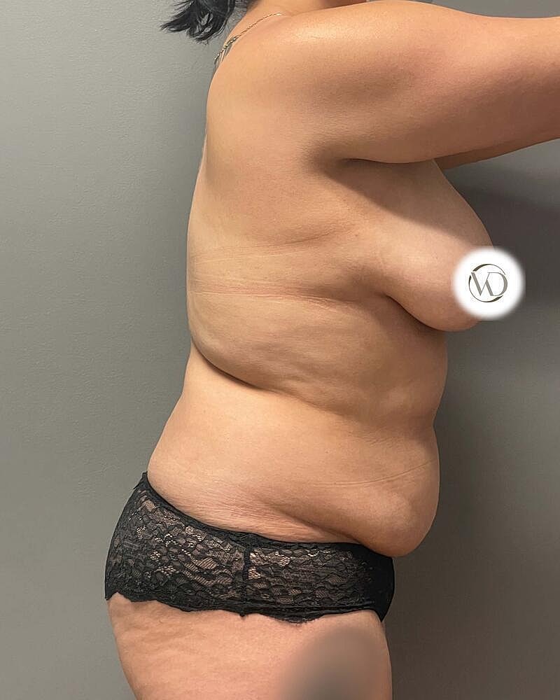 Tummy Tuck Before & After