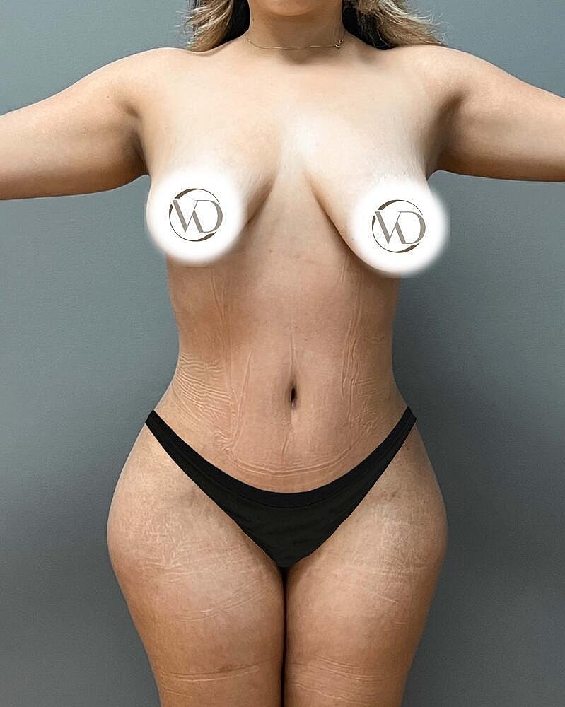 Tummy Tuck Before & After