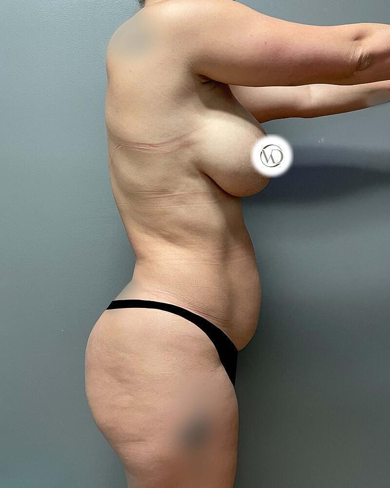 Tummy Tuck Before & After