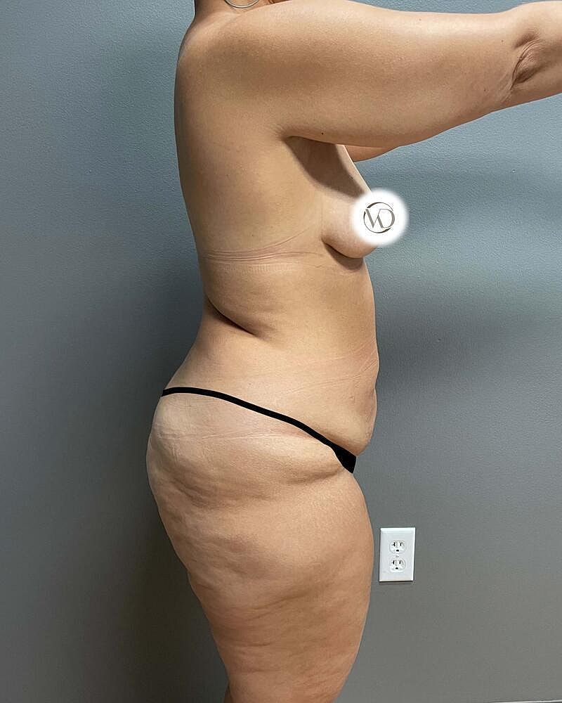 Tummy Tuck Before & After