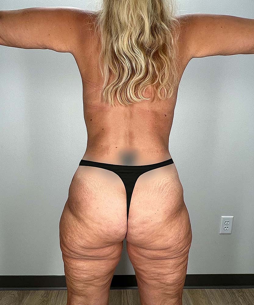 Tummy Tuck Before & After