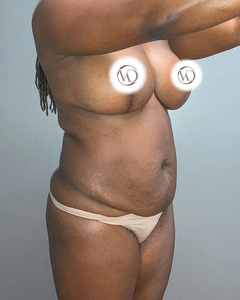 Tummy Tuck Before & After