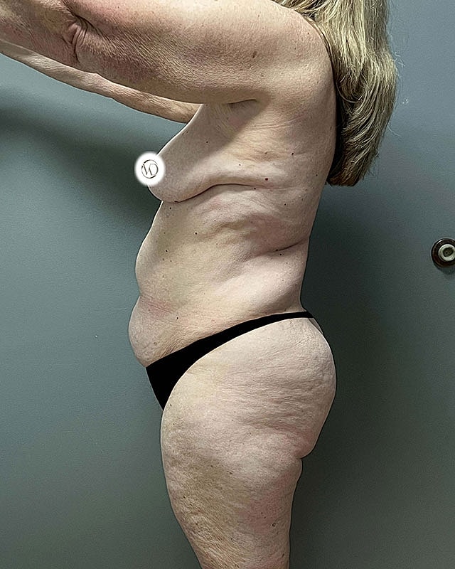 Tummy Tuck Before & After