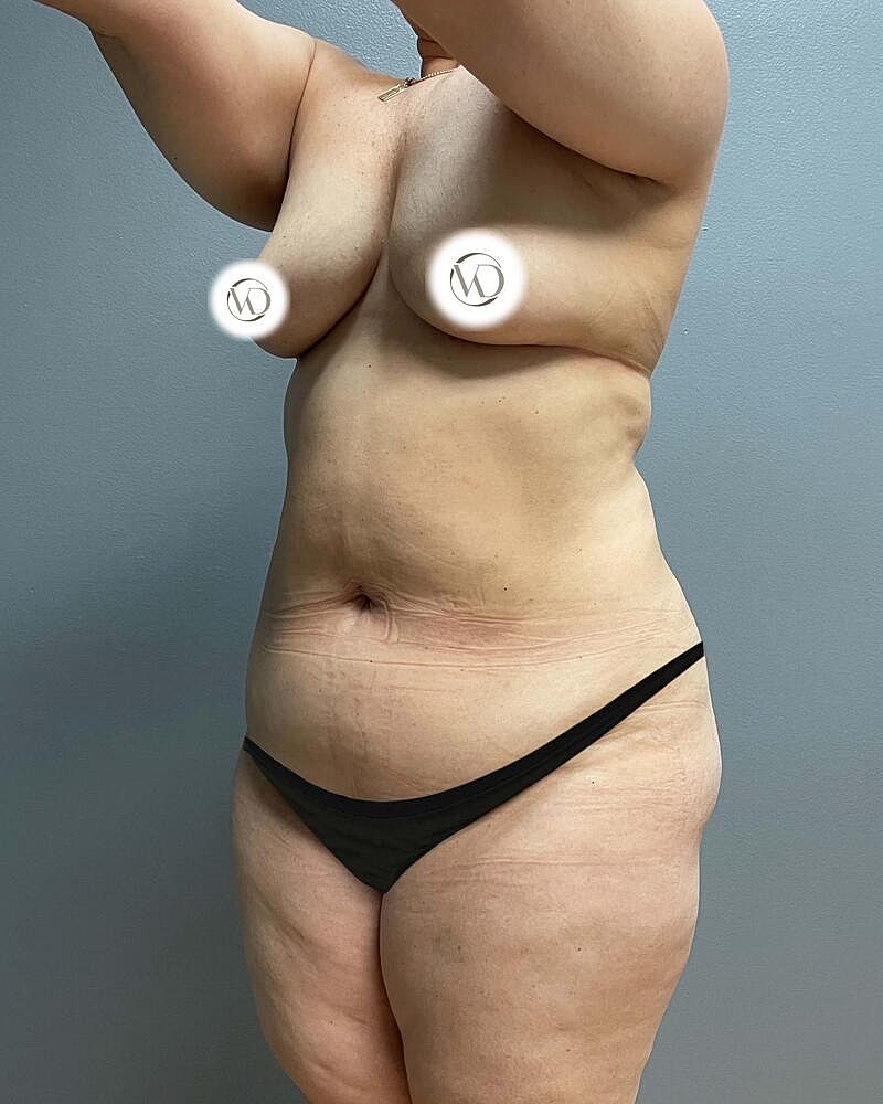 Tummy Tuck Before & After