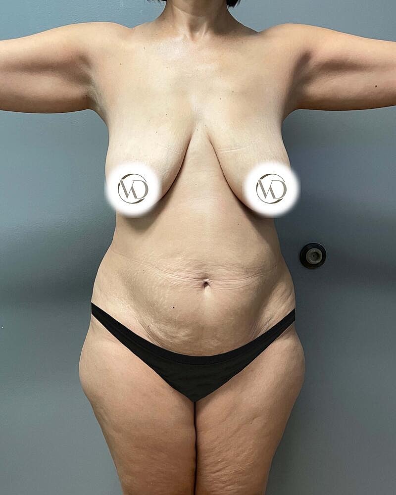 Tummy Tuck Before & After