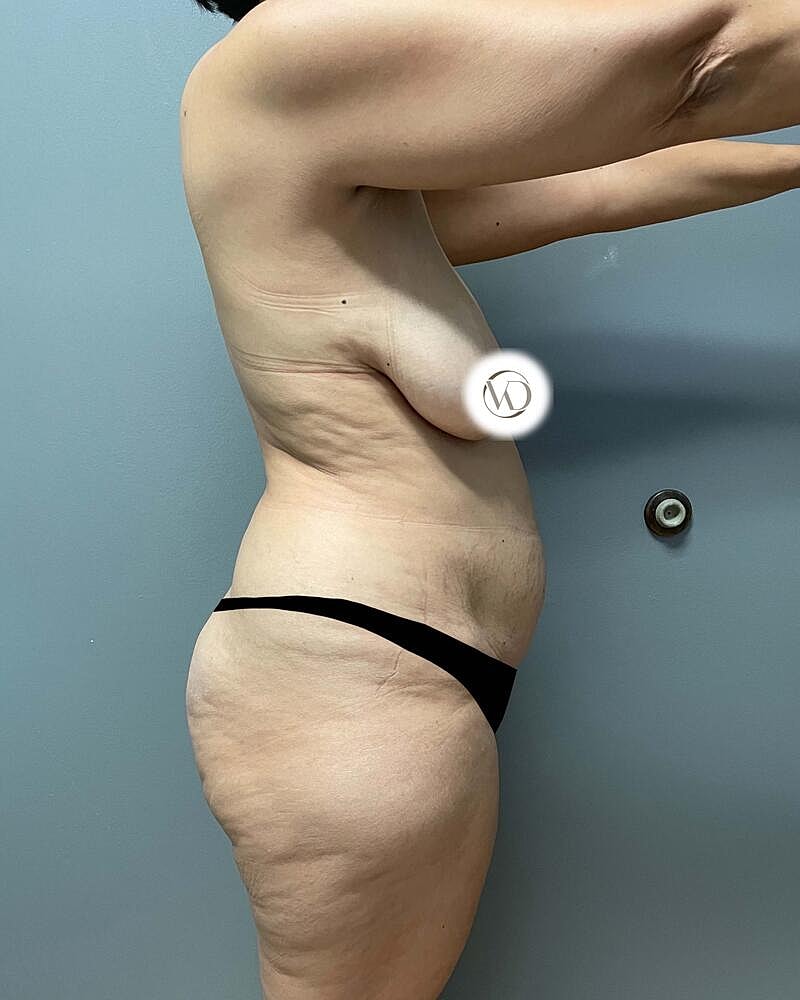 Tummy Tuck Before & After