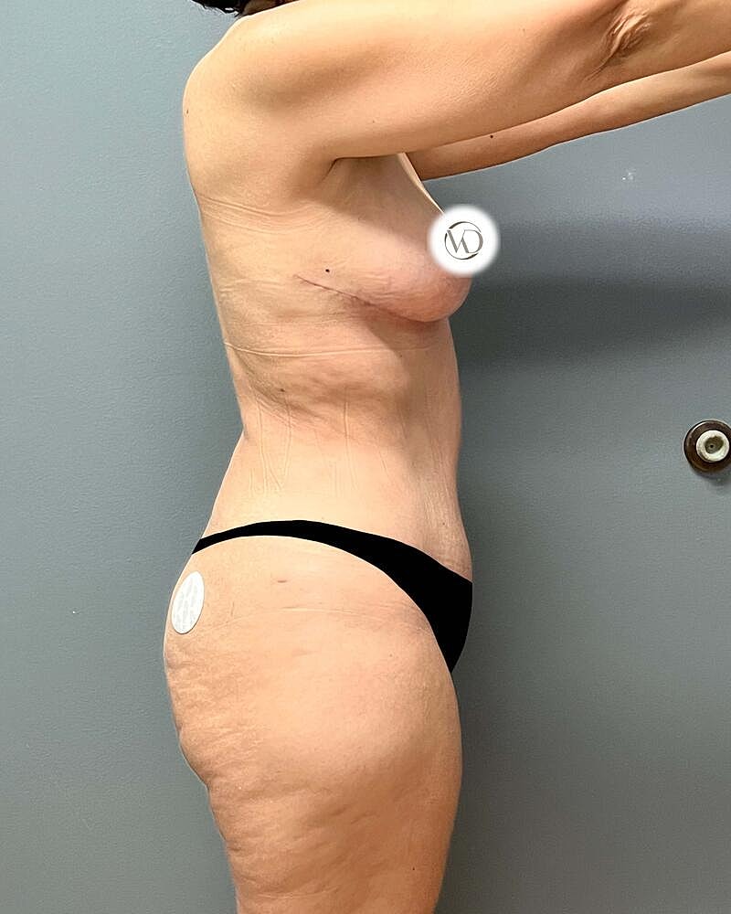 Tummy Tuck Before & After
