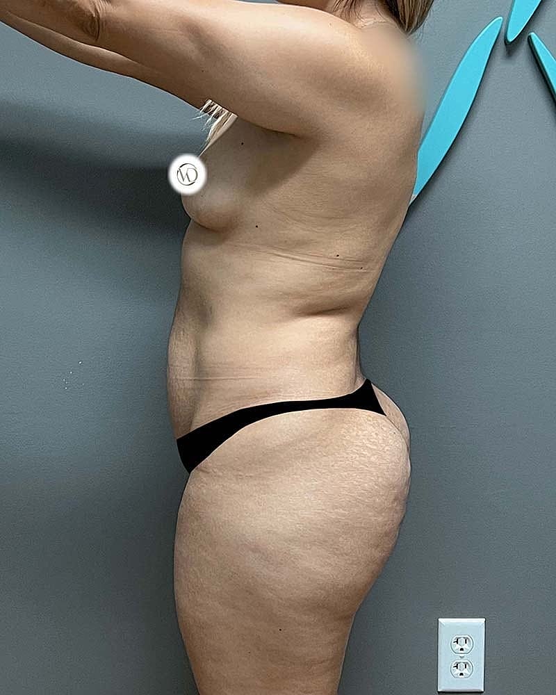 Tummy Tuck Before & After