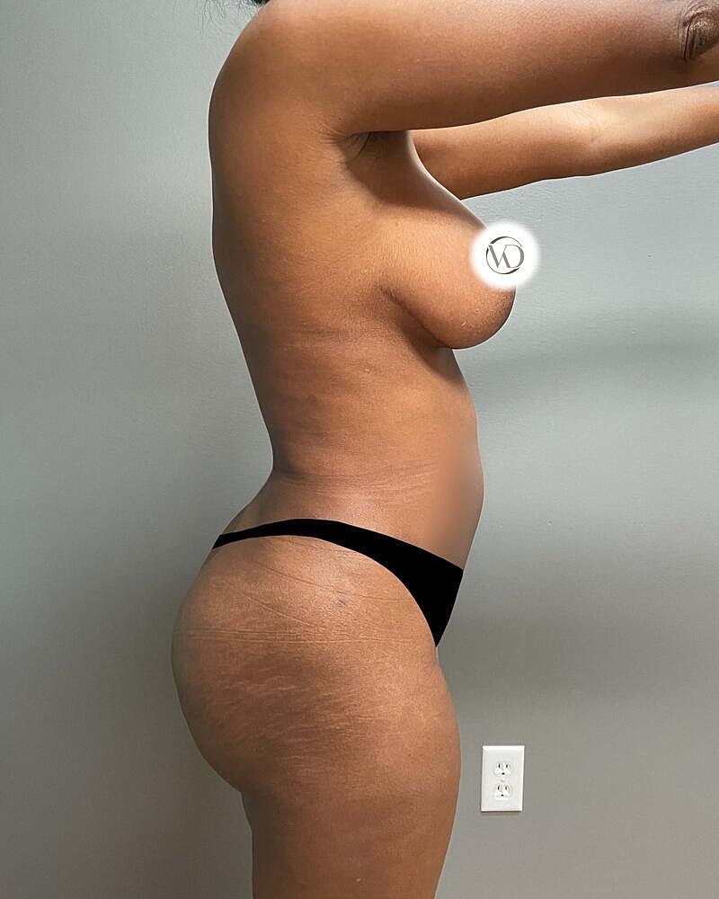 Tummy Tuck Before & After