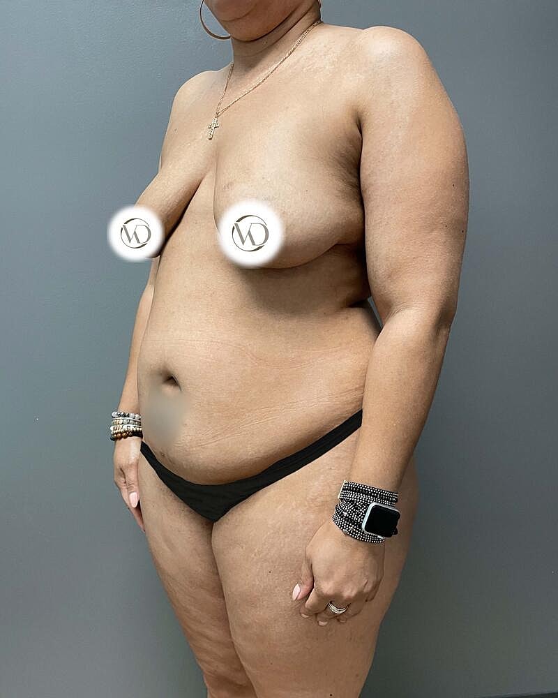 Tummy Tuck Before & After