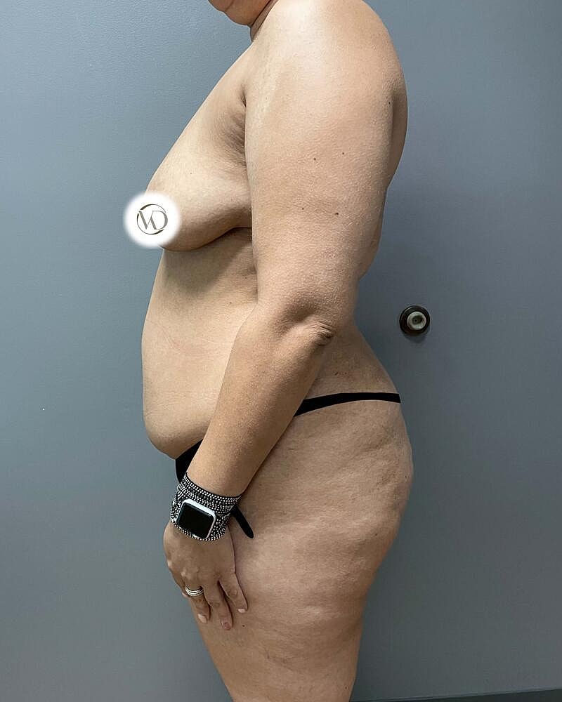Tummy Tuck Before & After