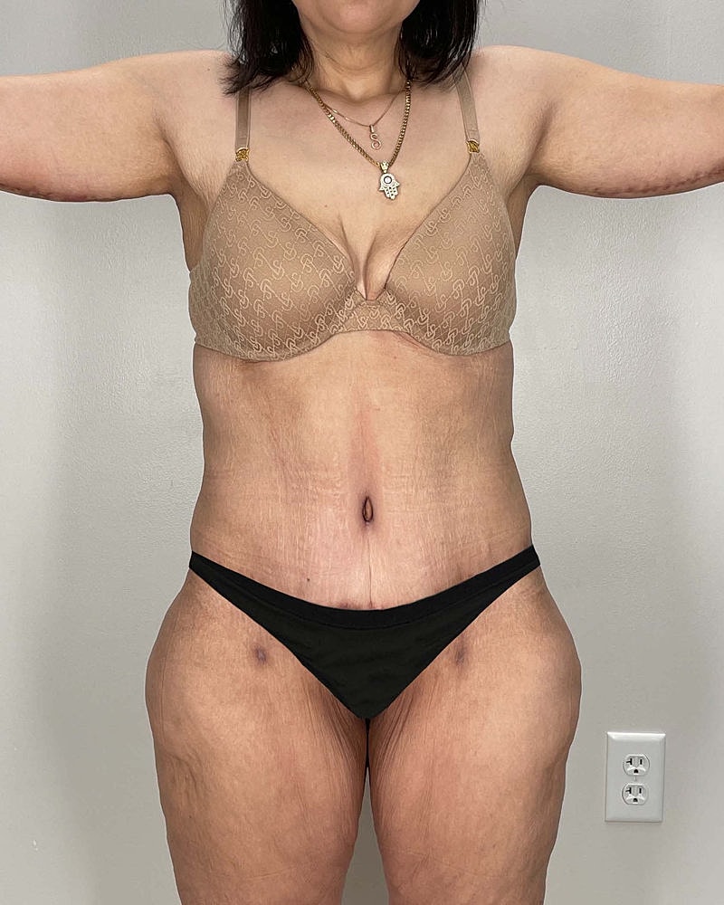 Tummy Tuck Before & After