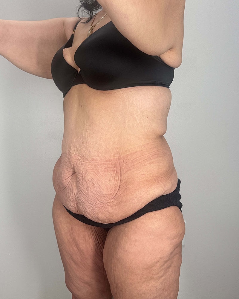 Tummy Tuck Before & After