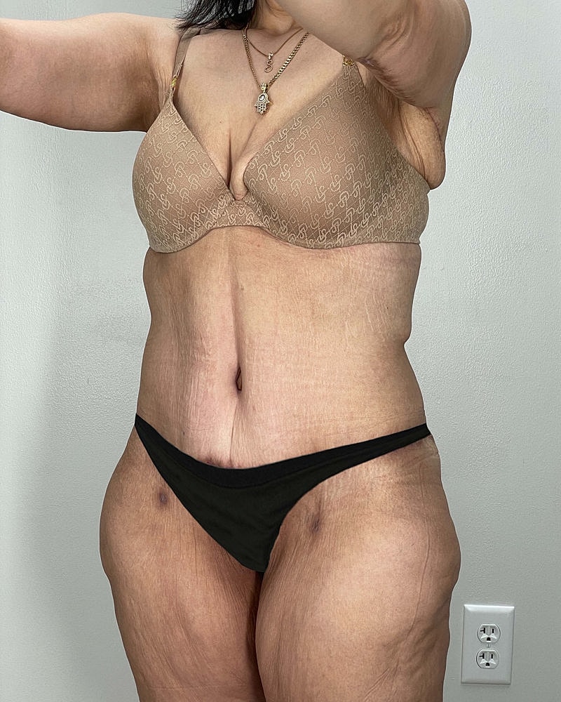 Tummy Tuck Before & After