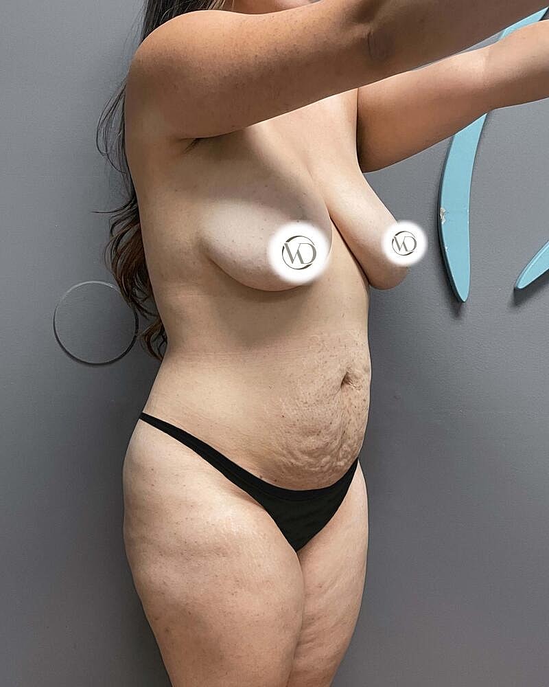 Tummy Tuck Before & After