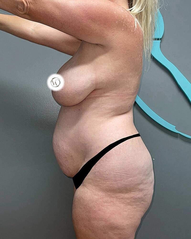 Tummy Tuck Before & After