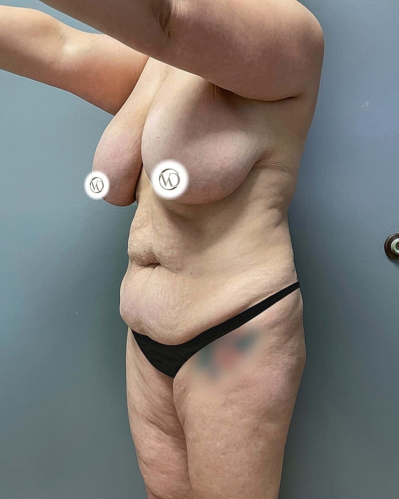 Tummy Tuck Before & After
