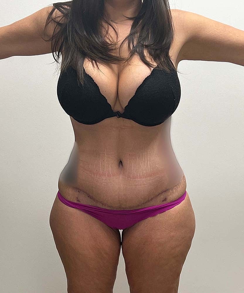 Tummy Tuck Before & After