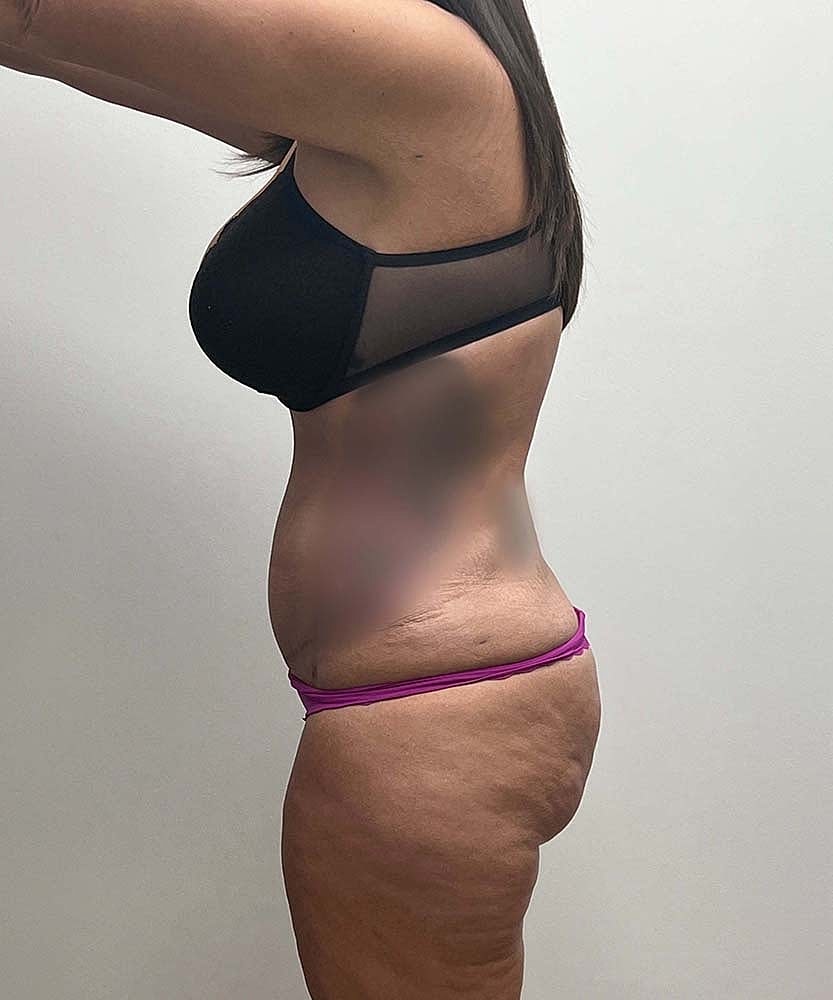Tummy Tuck Before & After