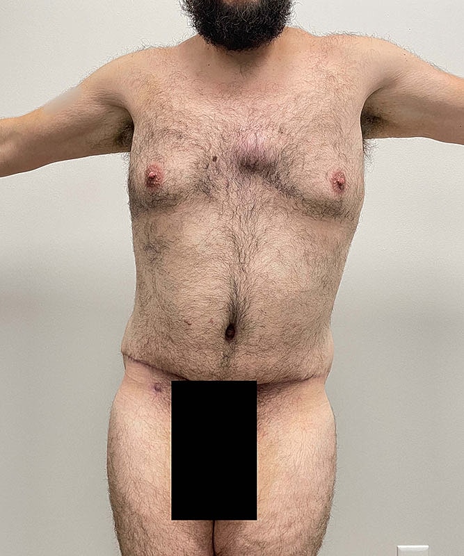 Tummy Tuck Before & After