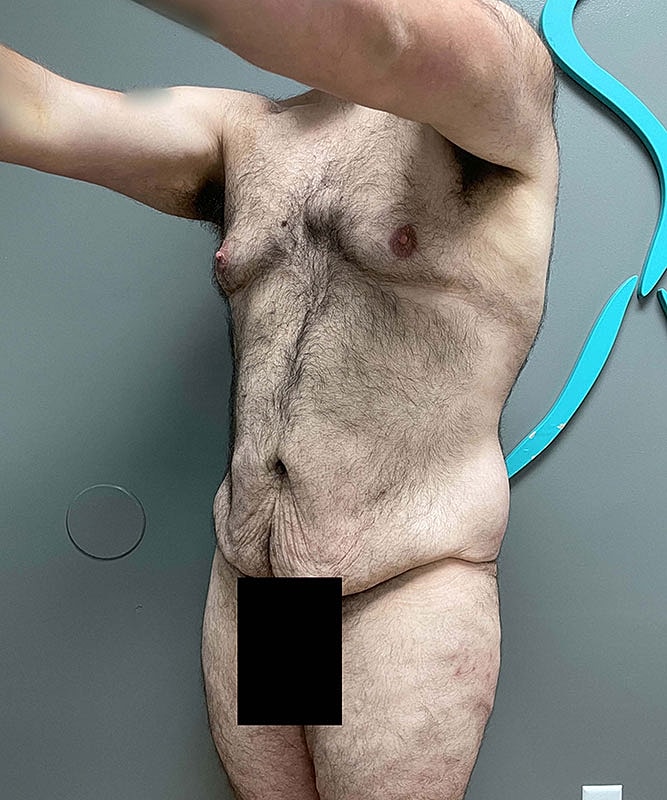Tummy Tuck Before & After