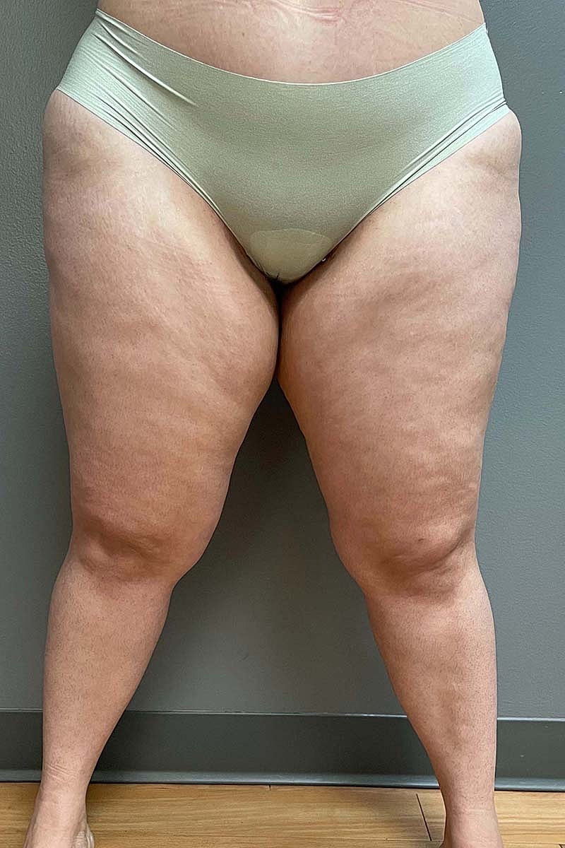 Liposuction Thighs Before & After