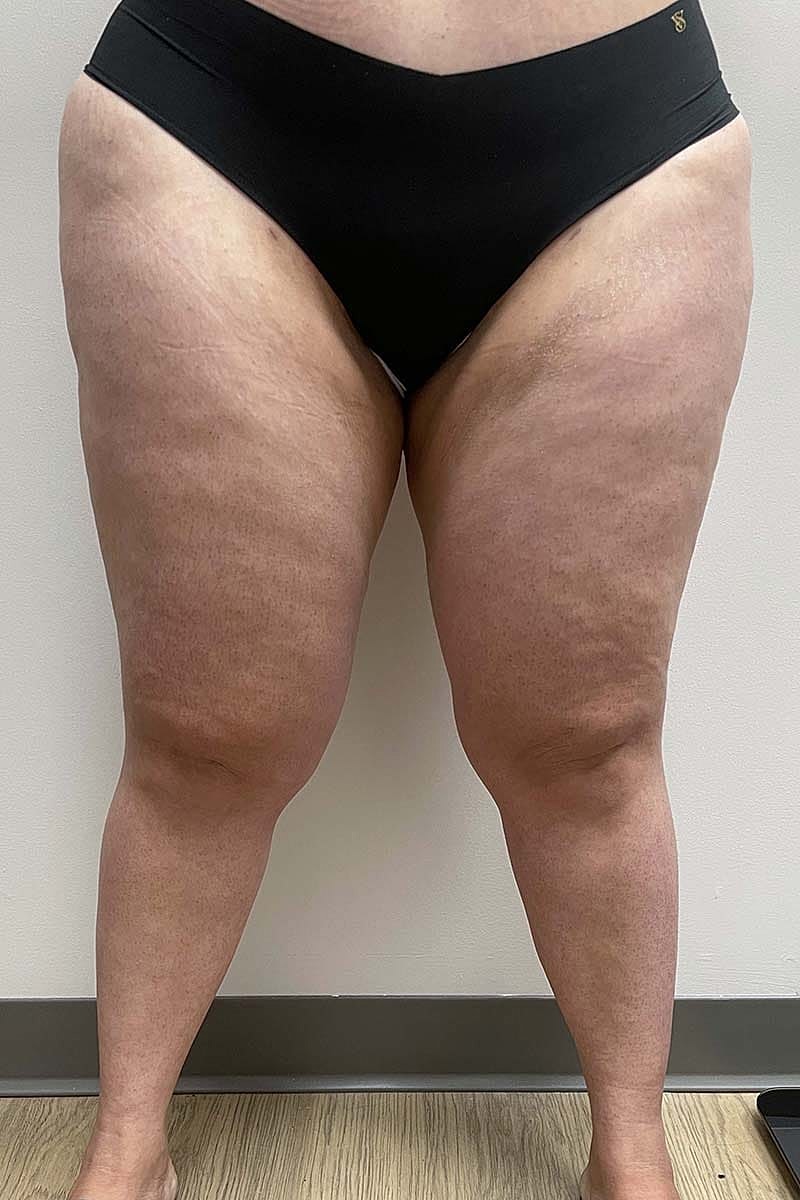 Liposuction Thighs Before & After