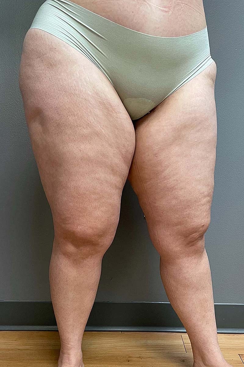 Liposuction Thighs Before & After